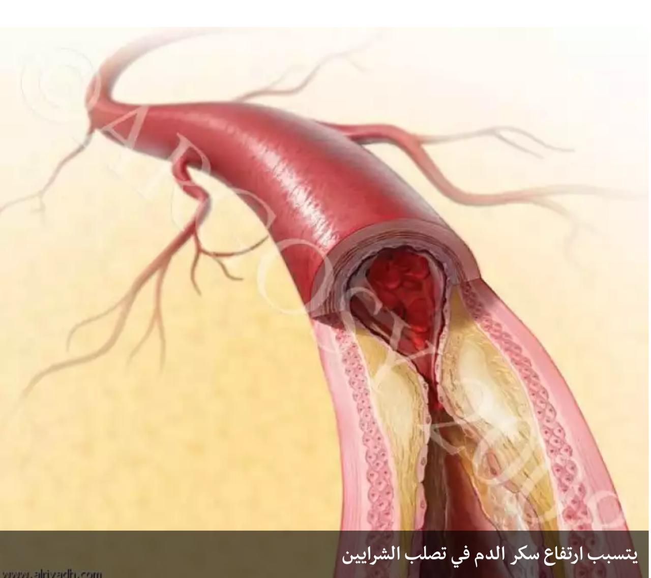 الأمراض الجلدية المرتبطة بداء السكري يمكن الوقاية منها..!