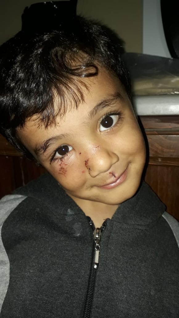 كلب ضال ينهش طفل عمره 3 سنوات في منشية بني حسن.
