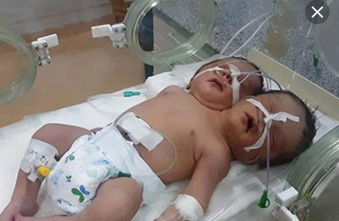 ولادة طفل برأسين وقلب واحد... في مصر