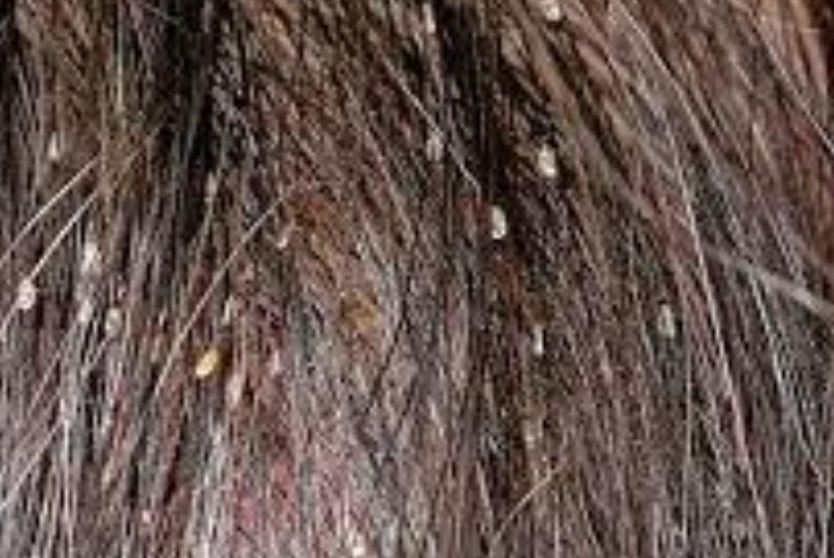 وفاة طفلة بسبب خلطة عشبية لعلاج القمل.... تفاصيل