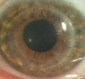 مناشدة مواطن يحتاج زراعة قرنية العين