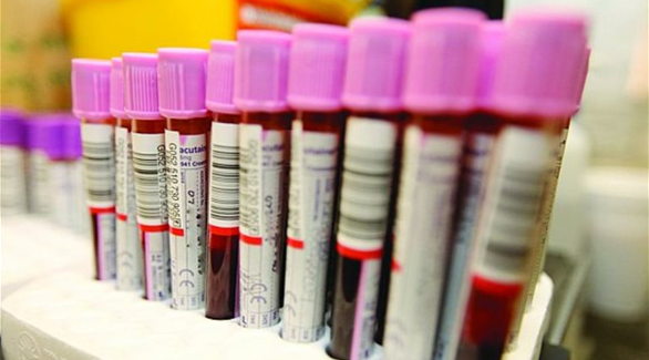 صحة اربد :سحب 80 عينة من مخالطي مصاب حوارة