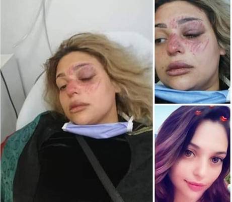 تونسية تروي قصة تعنيفها من عائلة زوجها بالأردن (صور)