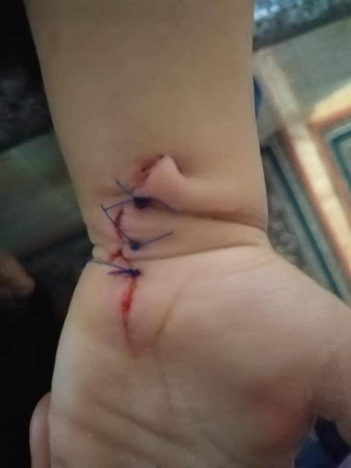 تشكيل لجنة تحقيق في خطأ طبي لطفل أثناء “خياطة جرح” في مستشفى اليرموك