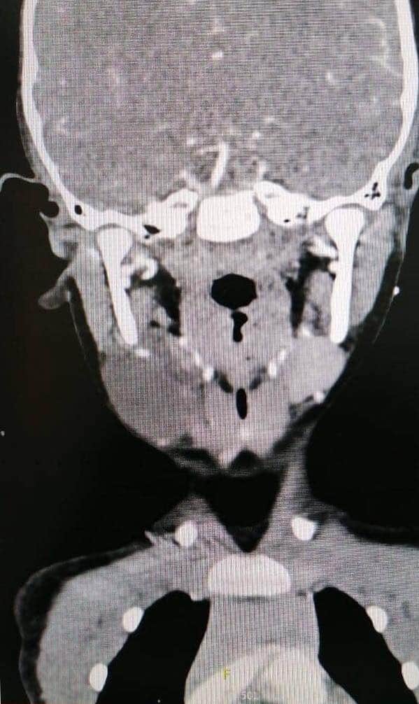 عملية استئصال كيس خلقي  في الرقبة Branchial Cleft Cyst في مدينة الحسين الطبية ...
