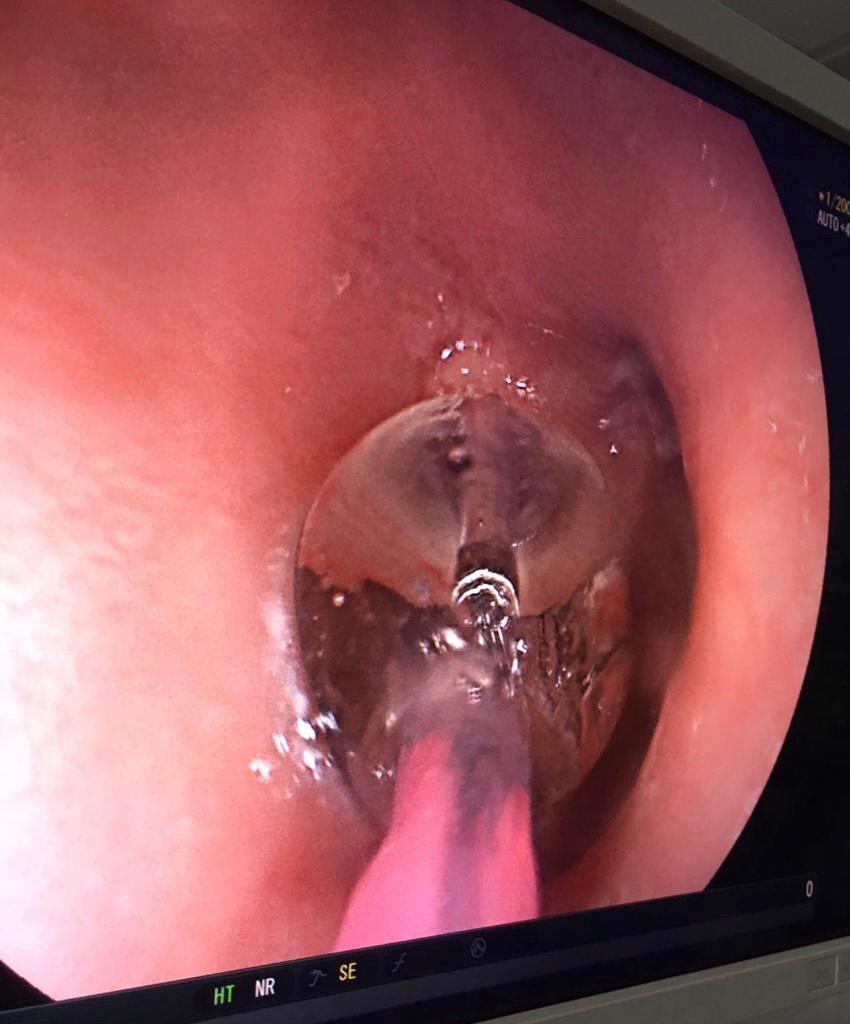 عمليّة نوعية لتوسعة مريء لطفلة تعاني من انسداد تام في مستشفى الجامعة