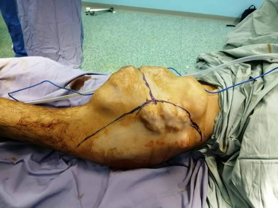 عملية نوعية لمريض ثلاثيني في مستشفى الملك المؤسس يعاني من ورم عظمي ضخم .. صور
