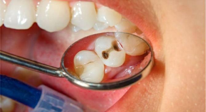 تجنب تسوس الأسنان  لإنه قد يسبب خراج وإلتهابات شديده
