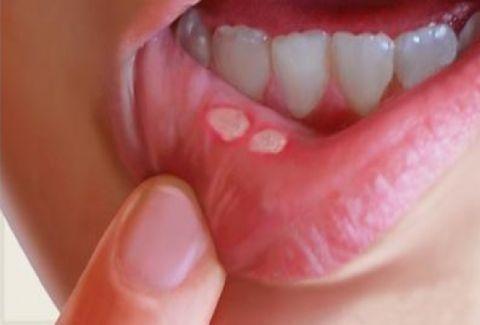 للتخلص من القلاع الفموي.. علاج منزلي مذهل
