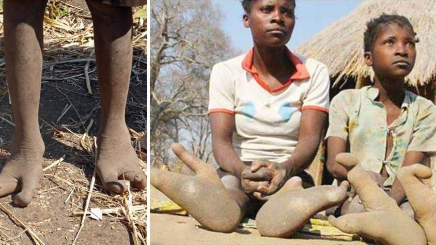 أغرب قبائل العالم.. أقدامهم بلا أصابع وتشبه النعام.. صور