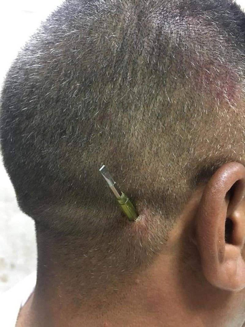 مصرية تغرس مفكًا في رأس شخص ألحّ على الزواج منها_ صور