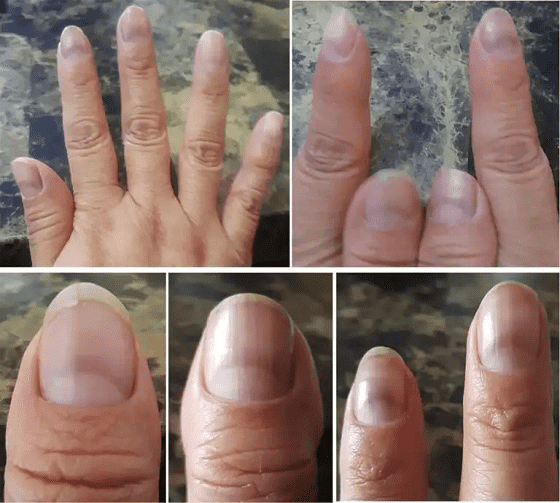 علامة على الأظافر تشير إلى الإصابة بفيروس كورونا