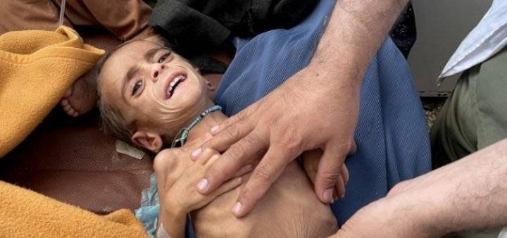 ملايين الأطفال في أفغانستان مهددون بسوء تغذية حاد