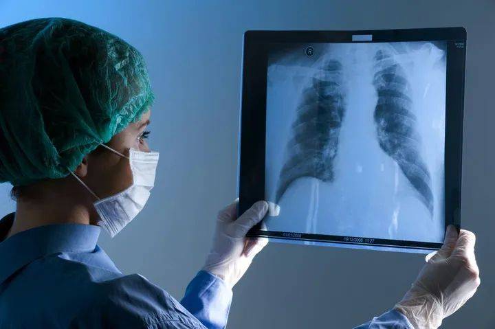 فئتان غير متوقعتان هما الأكثر عرضة للإصابة بسرطان الرئة!