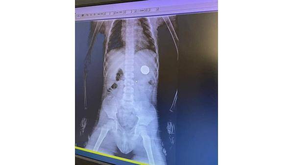 د.ابو رمان : استخراج ربع دينار معدني من معدة طفل عمره 5 سنوات