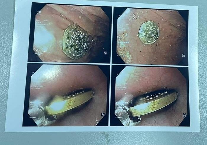 أول حالة تنظير للأطفال في مستشفى الحسين السلط الجديد