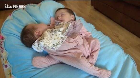 يرزقان بطفلتين ملتصقتين في حالة نادرة للغاية