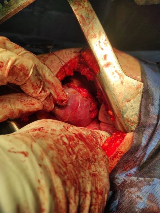 انقاذ مصاب بطعنة بالقلب من الموت بجامعة أسيوط