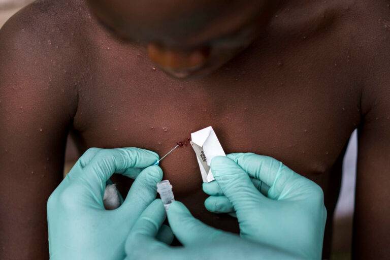 تعرّف على أعراض وتاريخ جدري القرود