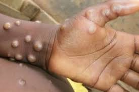 إسبانيا: رصد أول إصابة بجدري القرود