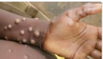 الصحة اللبنانية: لا حالات مثبتة حتى الآن بجدري القرود