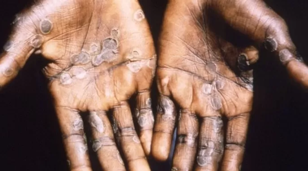 جدري القرود: منظمة الصحة العالمية تحذر من “تحديات هائلة تواجه العالم 