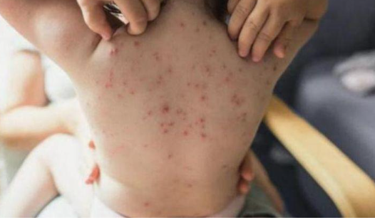 الصحة الألمانية تتوقع المزيد من الإصابات بجدري القرود