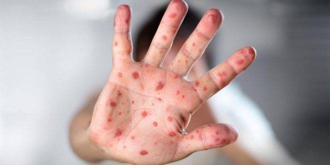 عاجل ..السلطات المغربية تعلن عن تسجيل 3 حالات مشتبه في إصابتها بجدري القردة