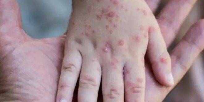 عاجل ..تشيكيا والنمسا وسلوفينيا يسجلون أولى الإصابات بجدري القردة