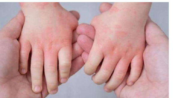 إنفلونزا الطماطم النادرة.. تسجيل 26 حالة إيجابية بالهند