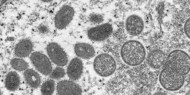 15 حالة إصابة مؤكدة بجدري القرود في كندا