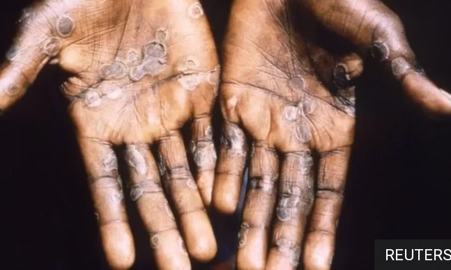 الصحة العالمية: خطر مرض جدري القردة على عامة الناس يُعدّ مُنخفضًا