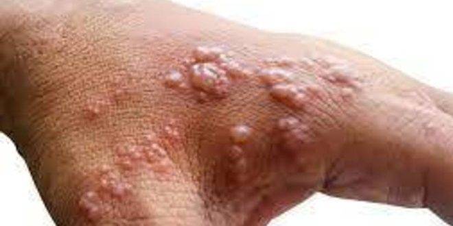 الأرجنتين تسجل أول إصابة بجدري القردة