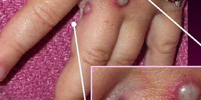 إيرلندا والمكسيك تسجلان أول اصابتين بفيروس جدري القردة