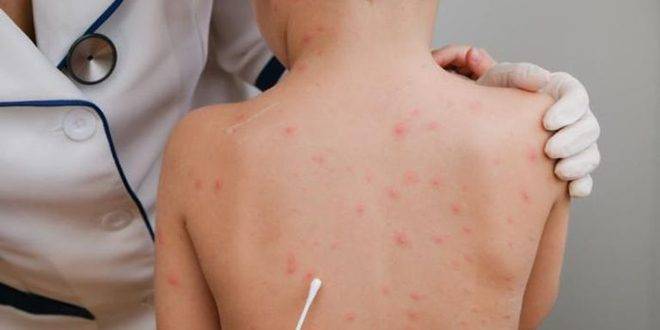 فرنسا.. 16 إصابة جديدة بجدري القردة