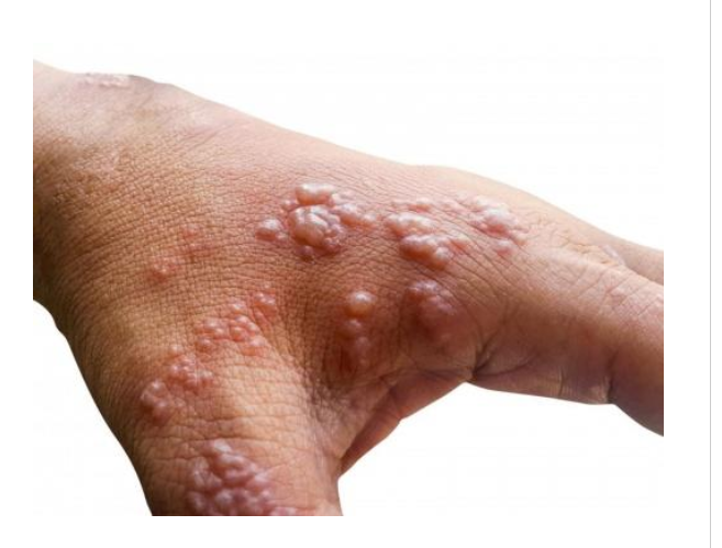 تسجيل أول حالة وفاة بمرض جدري القرود