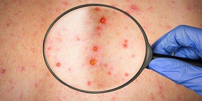 الصحة العالمية: من غير المحتمل أن يؤدي انتشار جدري القردة إلى جائحة