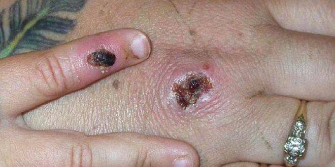 عاجل أول حالة وفاة في العالم بجدري القردة في نيجيريا