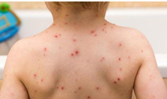 إصابات جدري القرود ترتفع لـ119 في البرتغال