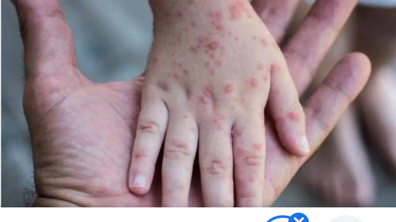 رصد أول إصابة بجدري القرود في المغرب