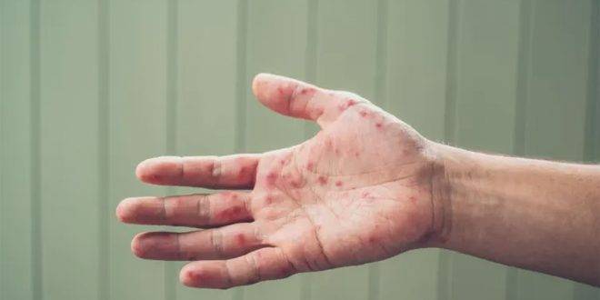 تسجيل 14 إصابة جديدة بفيروس جدري القردة في إسبانيا