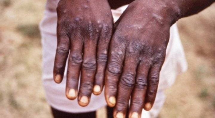 أفريقيا تسجل 1597 حالة اشتباه بجدري القرود بينها 66 وفاة