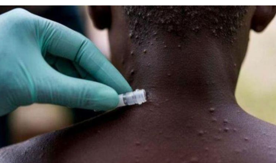 تسجيل اصابات بجدري القردة في 42 دولة