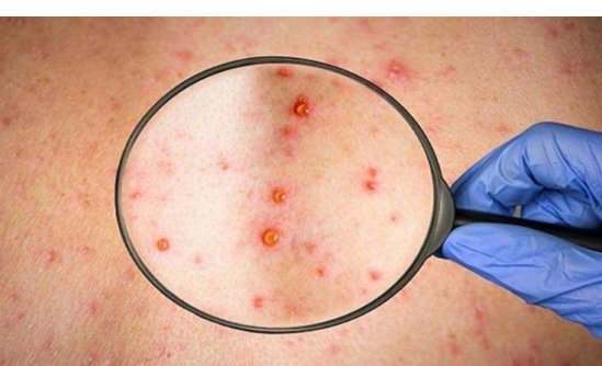 بريطانيا توصي بتلقيح المثليين ضد جدري القرود.. وتكشف السر !