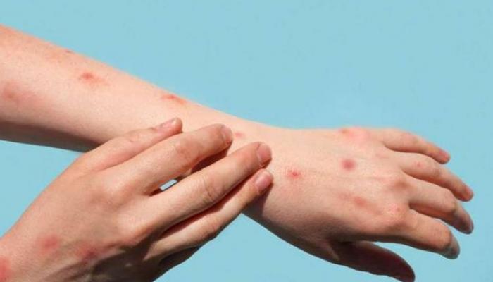 جدري القرود.. الصحة العالمية تدعو أوروبا إلى تحرك عاجل