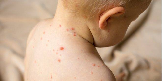 خلال (1530) دقيقة فقط.. جهاز صغير يكشف فيروس الحصبة