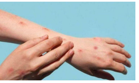 2000 إصابة بجدري القرود في ألمانيا