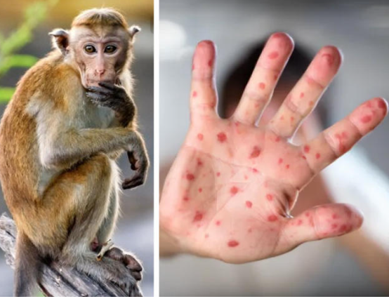 الصحة العالمية تدرس إمكان تصنيف جدري القردة حالة طوارئ عالمية