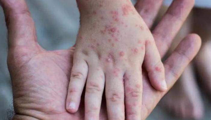 أمريكا تسجّل أولى الإصابات بجدري القرود بين الأطفال