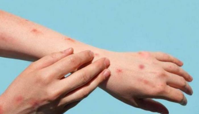 تسجيل أول وفاة بجدري القرود في إسبانيا